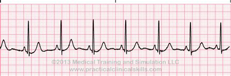 ecg nsr means|Normal Sinus Rhythm ECG Interpretation with Sample Strip.